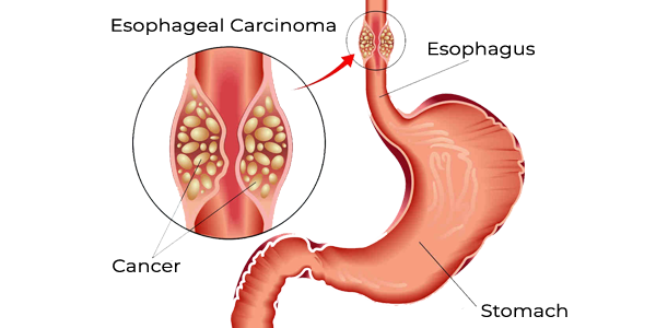 What Is VATS For Esophageal Cancer ? why is it done