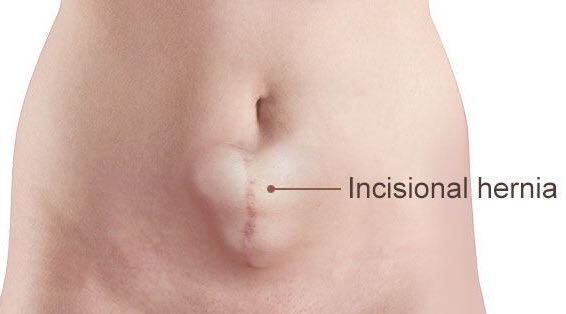 Incisional Hernia ? Causes,Symptoms,Treatment