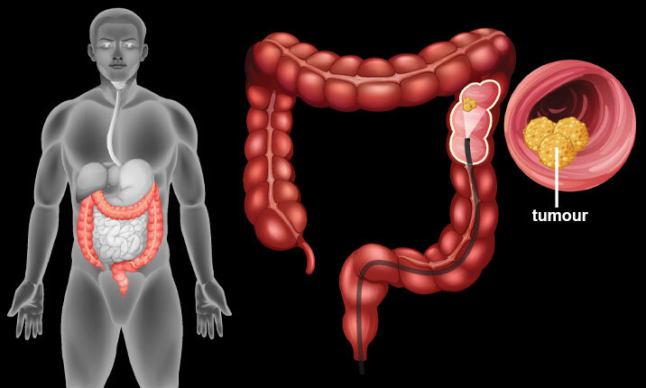 colorectal-cancer-tumour
