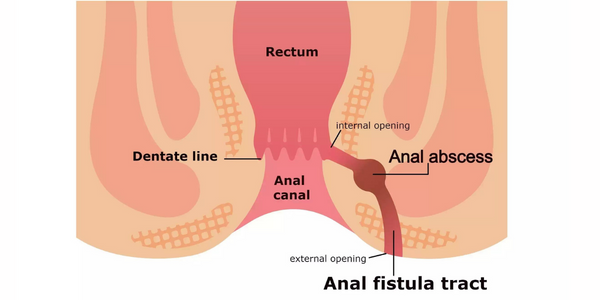 analfistula