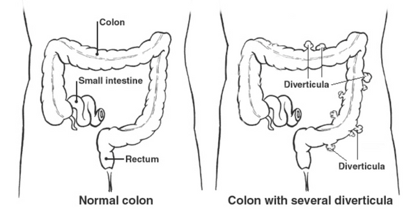 diverticulitis