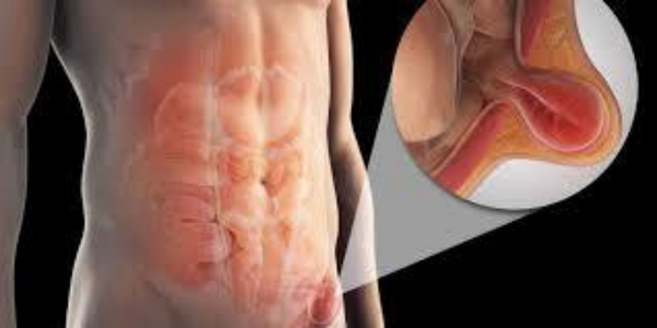 Femoral Hernia ? Causes,Symptoms,Treatment