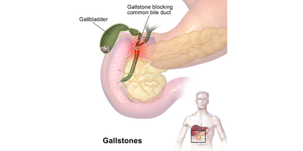 gallstones
