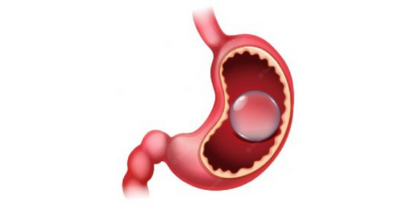 gastric-baloon