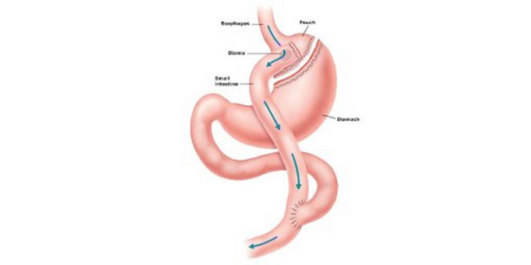 gastric-bypass