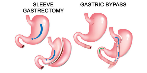 metabolic-surgery