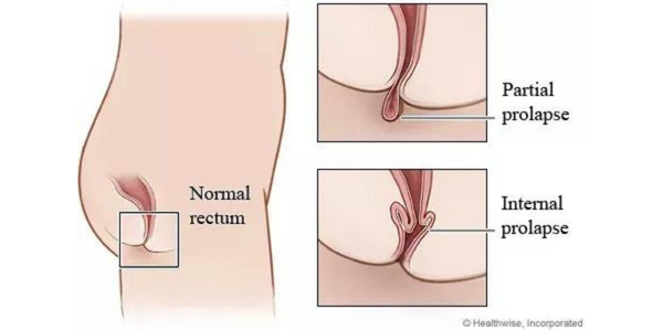 rectal-proplapse