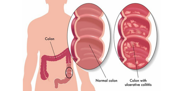 ulcerativecolitis