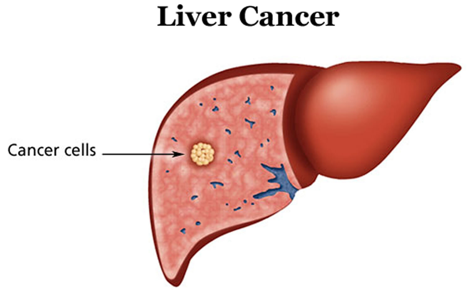 liver-cancer