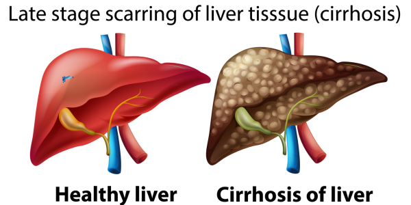 liver-cirrhosis